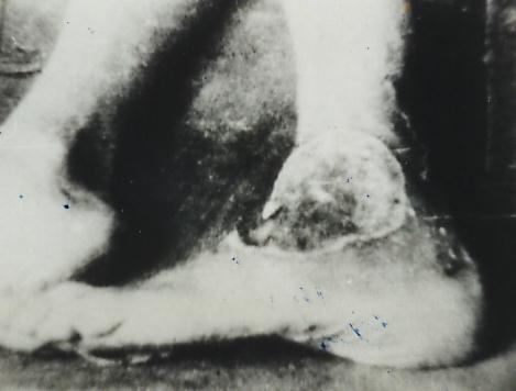 ulcer on ankle-1943